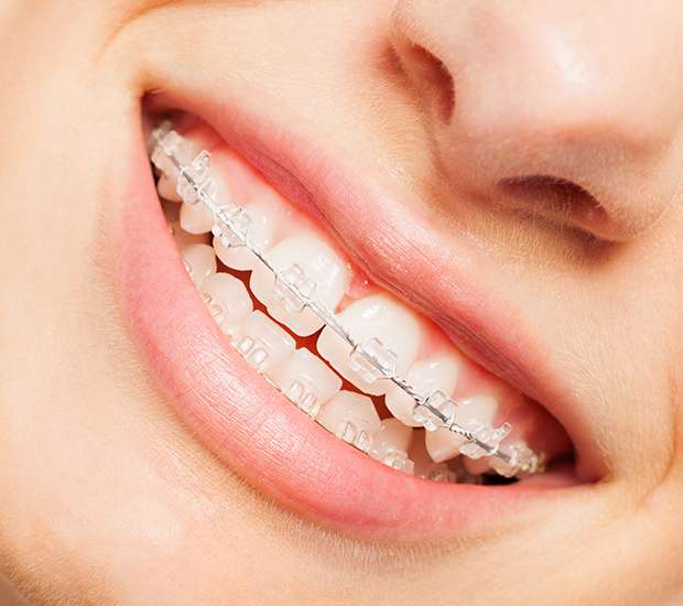 Palm Harbor Dentist Braces You for that Perfect Smile