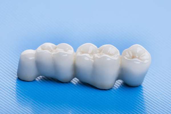 Replacing Old Dental Bridges