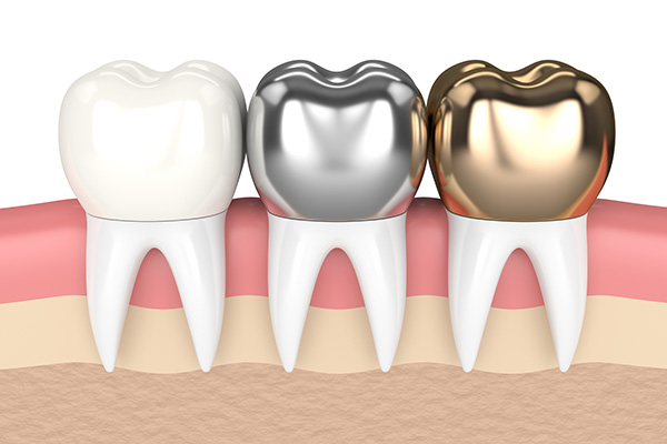 Dental Crowns with Bleaching