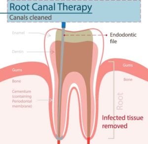 root canal